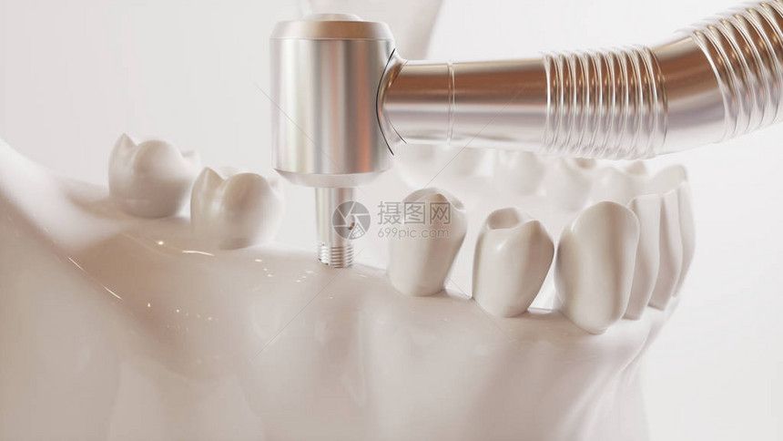 牙齿植入图片系列V023图片
