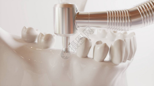 牙齿植入图片系列V023高清图片
