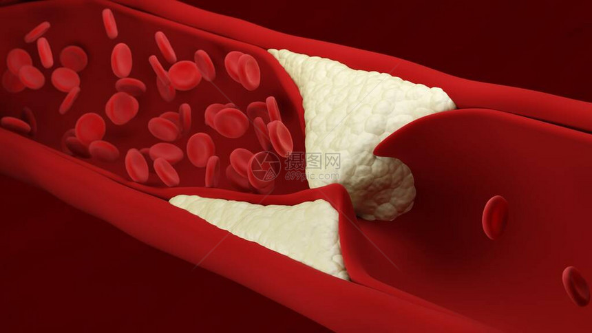 动脉粥样硬化红细胞动脉形成斑块动脉壁失去弹增厚和硬化血流量图片