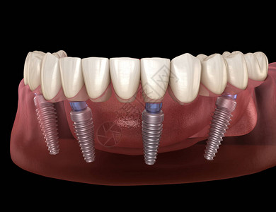 下颌假体Allon4系统由植入物支持人类牙齿和假牙概念的医学上准确的图片
