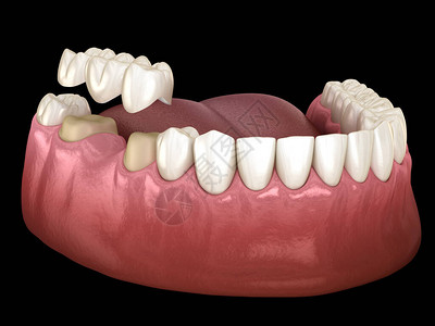 用于人体牙齿治疗的医学精确3D插图图片