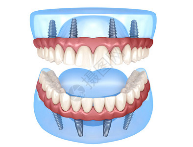 带牙龈的上颌和下颌假体全部在4个系统上图片