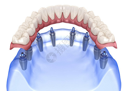 带牙龈的上颌和下颌假体全部在8个系统上背景图片