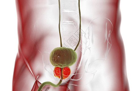 腺瘤3D显示前列腺扩大的3D图设计图片