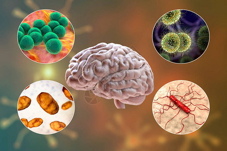 细菌脑膜炎的病因高清图片