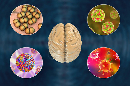 脑感染微生物引起脑炎和高清图片