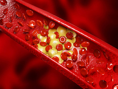 健康的人类红细胞和胆固醇斑块3d渲染图片