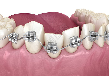 异常牙齿姿势和清晰牙套对立医学上准确的图片
