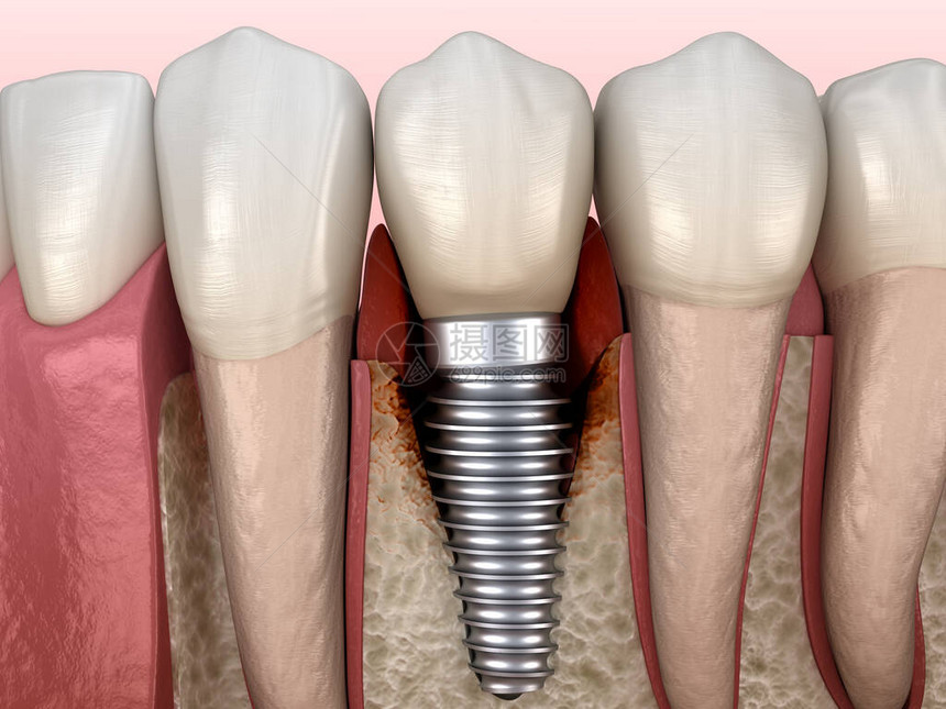在医学上准确的牙科植入概念3D插图283112A眼部骨损伤可见图片