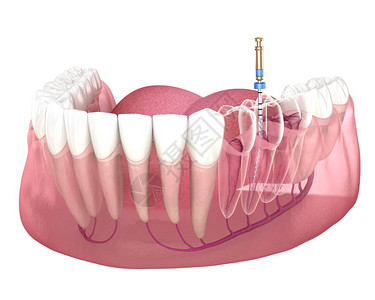 牙髓肾上腺液管治疗过程医学精确插画