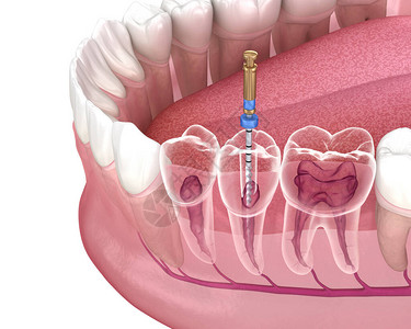 牙髓病学肾上腺液管治疗过程医学精确设计图片