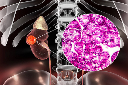 肾癌肾细胞癌3D插图和光显微照片背景图片