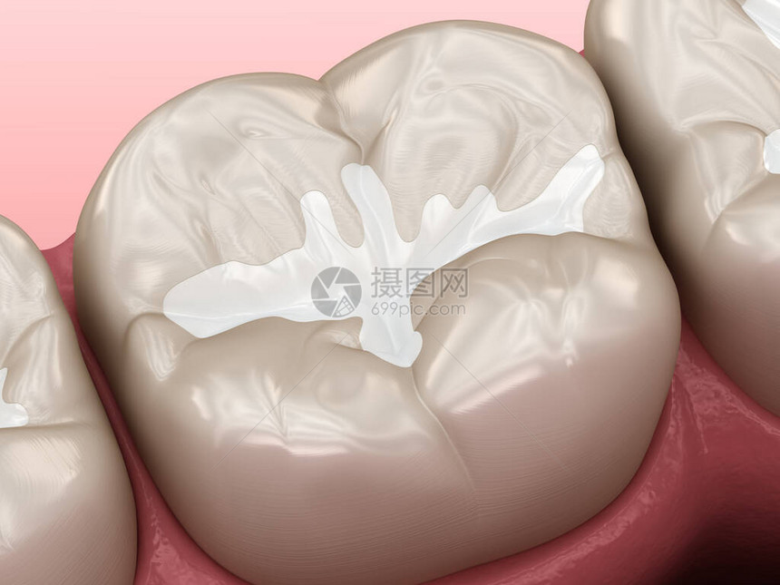 MolarFissure牙科填充物医学准确的牙科图片