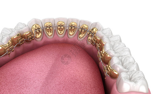 带金牙套白牙概念牙科3D插图片