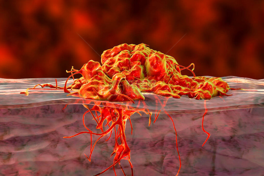 入侵癌症增长3D图例显示肿瘤侵图片