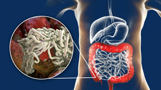 手足口病人类大型肠道中的寄生虫设计图片