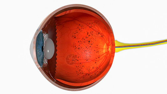 脉络膜视网膜炎色素性视网膜炎设计图片