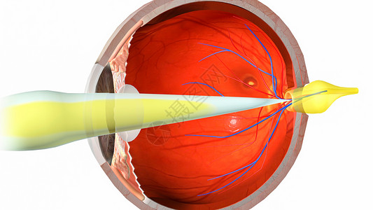 右视网膜中央动脉日光性视网膜病变设计图片