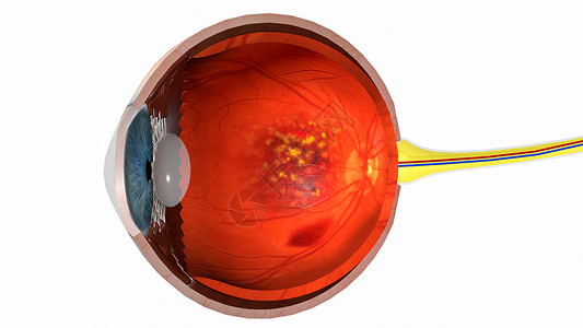 增生性糖尿病视网膜湿性黄斑变性设计图片