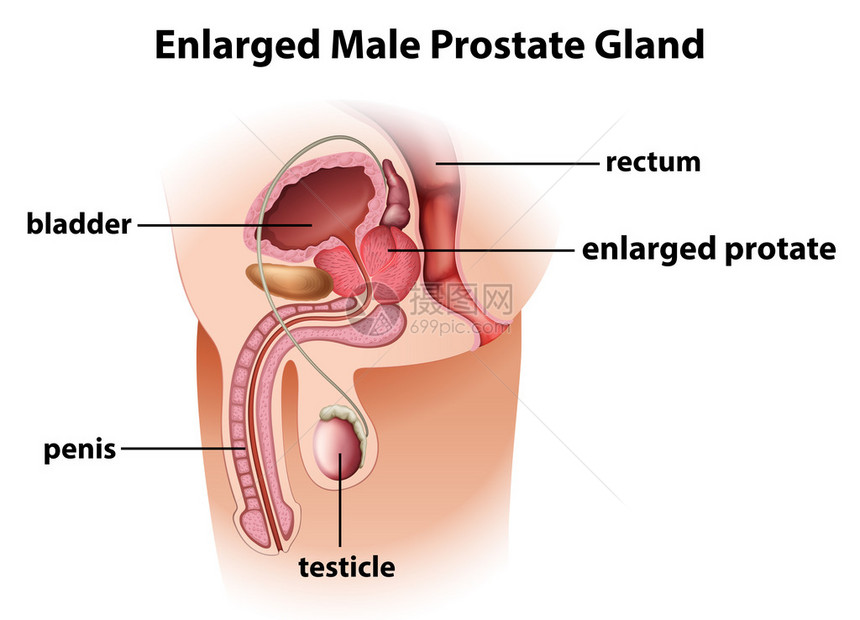 男前列腺肿大图片