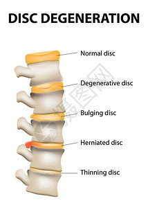 洛桑椎间盘退变是脊椎老化的正常磨损过程椎间盘失去弹弹插画