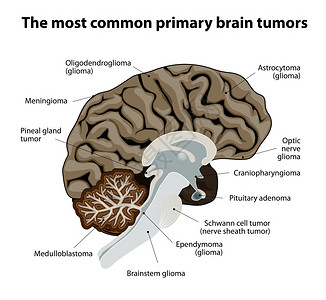 颅内最常见的原发脑肿瘤插画