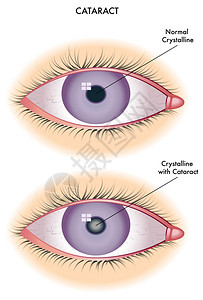 白内障图片