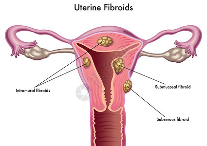 子宫肌瘤背景图片