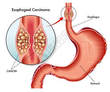 人食管癌药膳食管癌高清图片