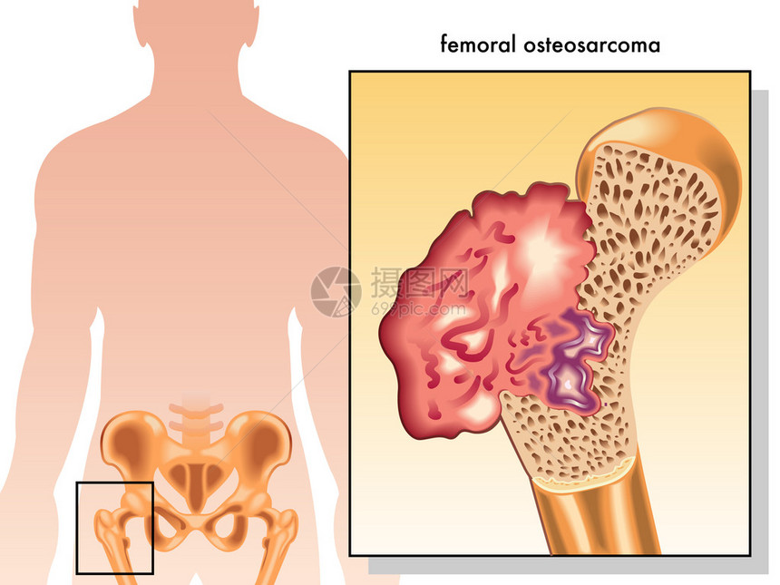 人类股骨肉瘤图片
