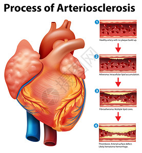 刚硬动脉粥样硬化的过程插画