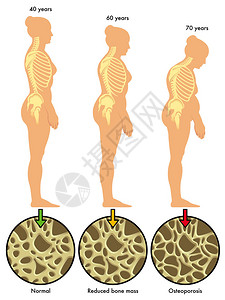 生长激素多彩的骨质疏松症计划插画
