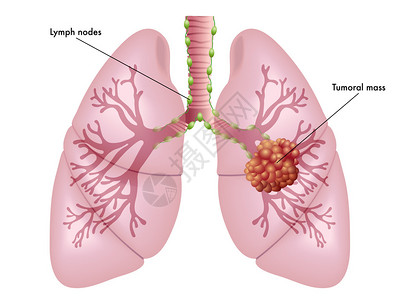 石棉肺癌的症状的插图插画