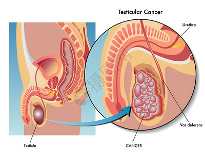 睾丸癌疗效的医学插图图片