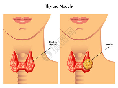嗓子痛医学插图的甲状腺癌的疗效插画