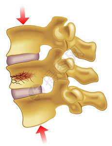 颈椎寰椎椎体压缩骨折的症状插画