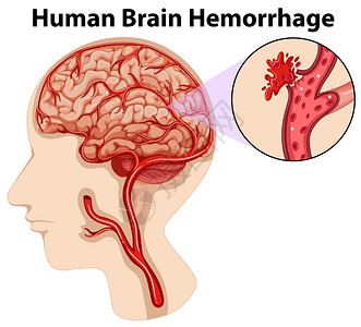 人类的大脑出血的关系图图片