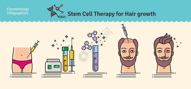 发际线后移设置与毛发生长的干细胞治疗的矢量图解插画
