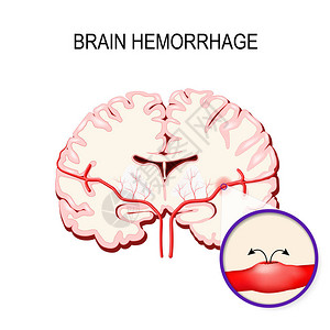 动脉瘤脑出血人脑内的中风和出血插画