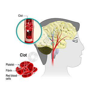 动脉瘤脑梗塞脑中风阻塞是由脑动脉中形成的血凝块引起的血细胞阻塞血流插画