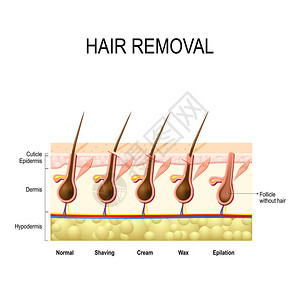永久脱毛用蜡奶油脱毛和剃须脱毛去除毛干的高度插画
