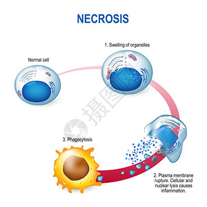 体内代谢坏死病理细胞导致活组织中细胞过早死插画