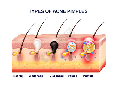 皮肤痤疮解剖组成图片