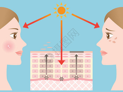 美容淡斑皮肤斑点的机制插画