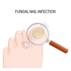 真菌指甲感染甲癣或甲癣是指甲的真菌感染图片