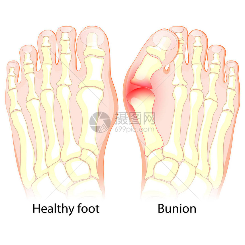 与Bunion合起来的健康的脚和图片