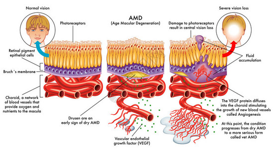 黄斑变性年龄相关黄斑插画