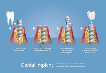 人类的牙齿与牙科植入物矢量图图片