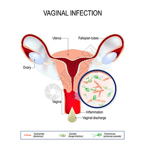 阴道的阴道感染及致病因子高清图片