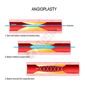 血管成形术支架植入已放气的球囊导管插入因斑块变窄的冠状动脉球囊膨胀插画